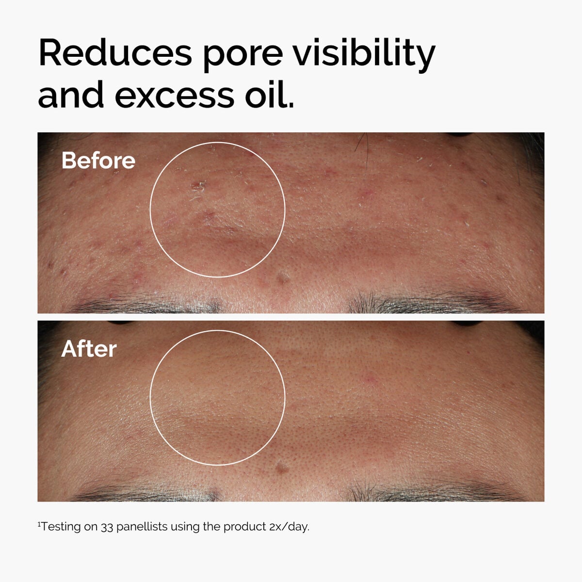 niacinamide-10-zinc-1-g5 ord-niacinamide-zinc-blemish-serum-before-after-pores.jpg