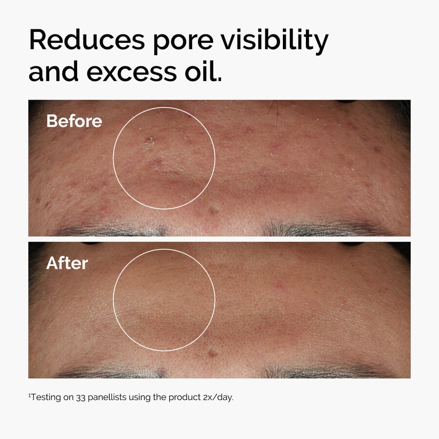 niacinamide-10-zinc-1-g5 ord-niacinamide-zinc-blemish-serum-before-after-pores.jpg