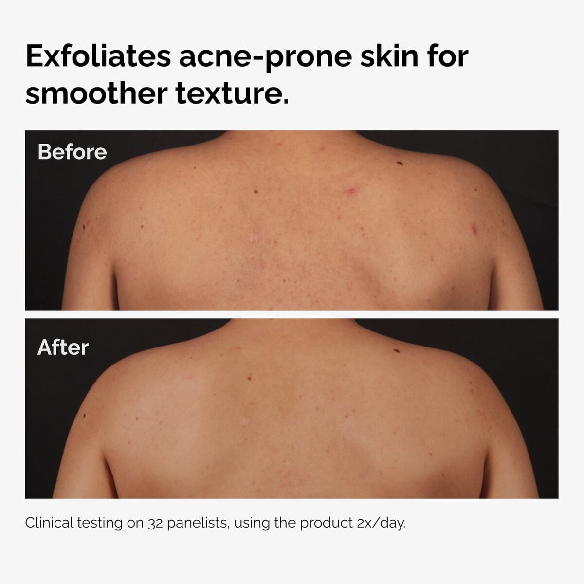 salicylic-acid-0-5-body-serum-i1 ord-salicylic-acid-body-serum-before-after-graphic-NA.jpg